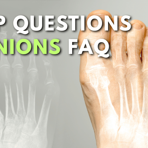 Top Questions About Bunions