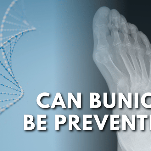 Can Bunions Be Prevented?