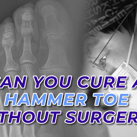 Can you cure a hammer toe without surgery?