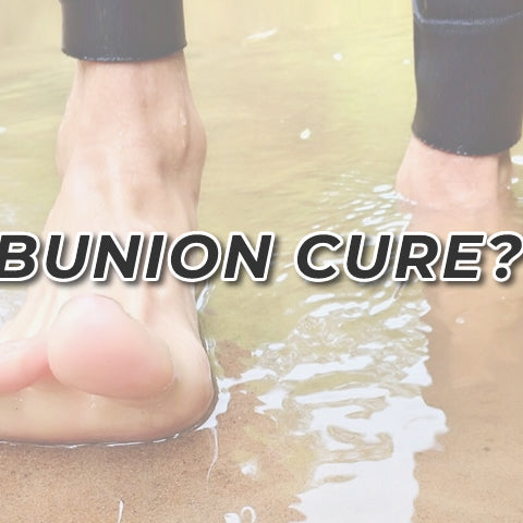 Is There a Cure for Bunions?