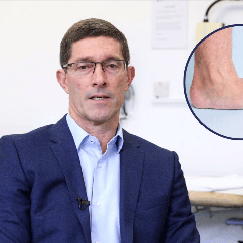 Dr. Garth Allardice Explains What Causes Flat Feet