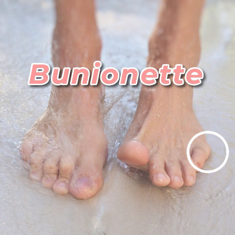 What is a Bunionette?