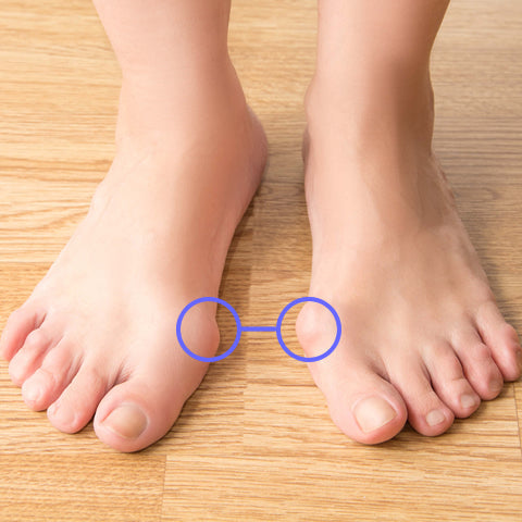 What is a Bunion?